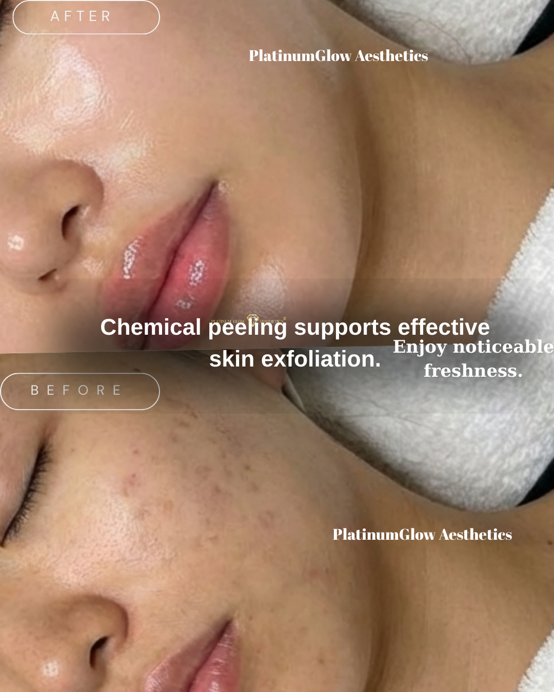 BioRePeel chemical peel treatment for acne and skin rejuvenation And pigmentation